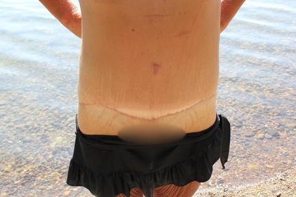 12 weeks post op