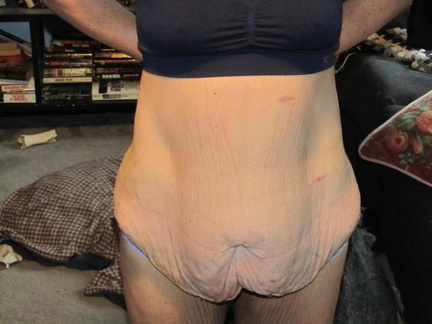 12 weeks post op