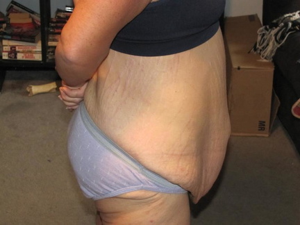 2 weeks before surgery
