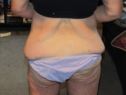 2 weeks before surgery