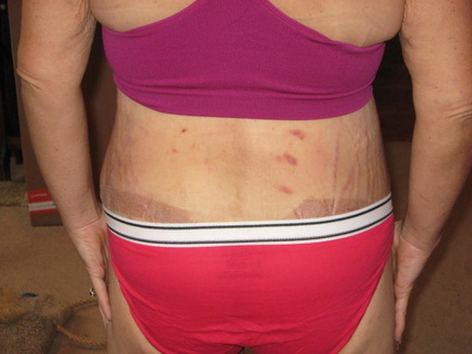 2 weeks post op