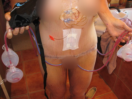 1 day post op